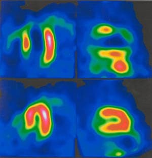 Illustration LE TECHNETIUM MEDICAL POURRAIT PROVENIR DES CYCLOTRONS