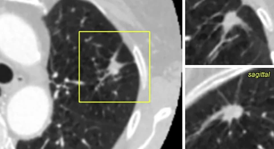 Un nouveau modèle de classification des nodules pulmonaires par deep learning à l'étude