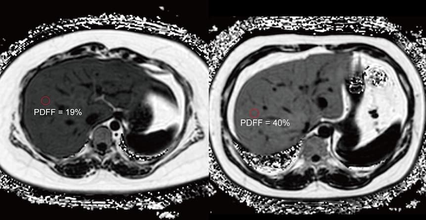 Prévoir le risque de diabète grâce à la fraction de densité de protons