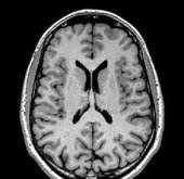 IRM cérébrale