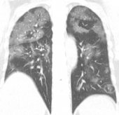 Scanner pulmonaire COVID