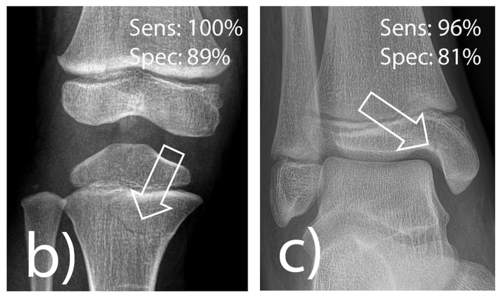 Illustration Une IA dédiée pour identifier les fractures en radiologie pédiatrique