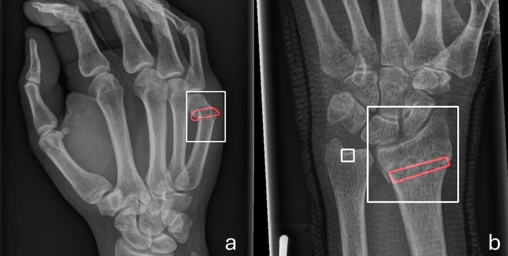 Illustration Une IA entraînée sur des cohortes hétérogènes est plus performante pour identifier les fracture en radiographie