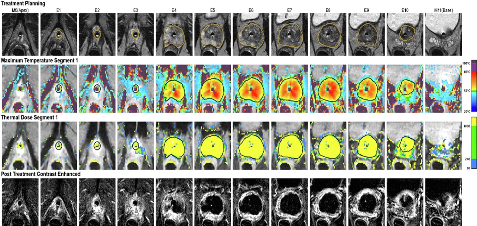 Illustration La TULSA guidée par IRM pour traiter le cancer de la prostate localisé