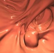 Illustration Retour sur 20 ans de recherches sur le dépistage du cancer du colon par coloscanner