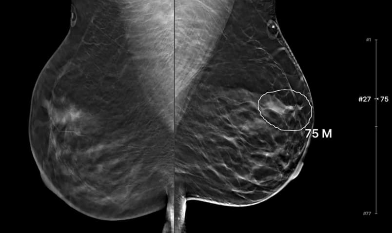 Illustration L'IA améliore le diagnostic de cancer d'intervalle par tomosynthèse