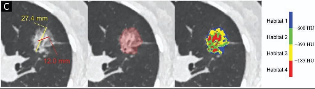 Illustration Une nouvelle approche tomodensitométrique pour explorer les nodules pulmonaires subsolides
