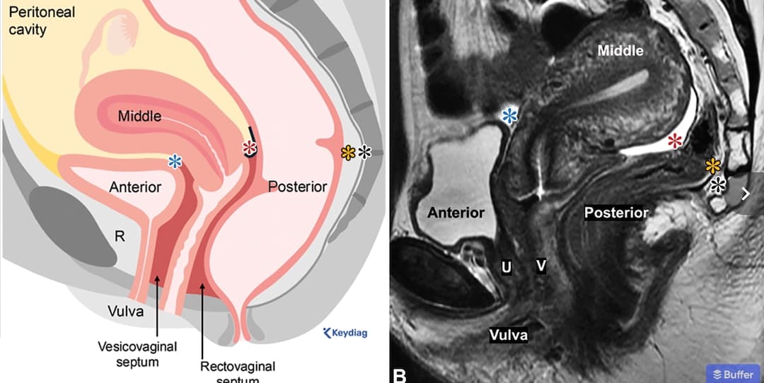Illustration Une revue exhaustive des indications d'IRM pelvienne gynécologique