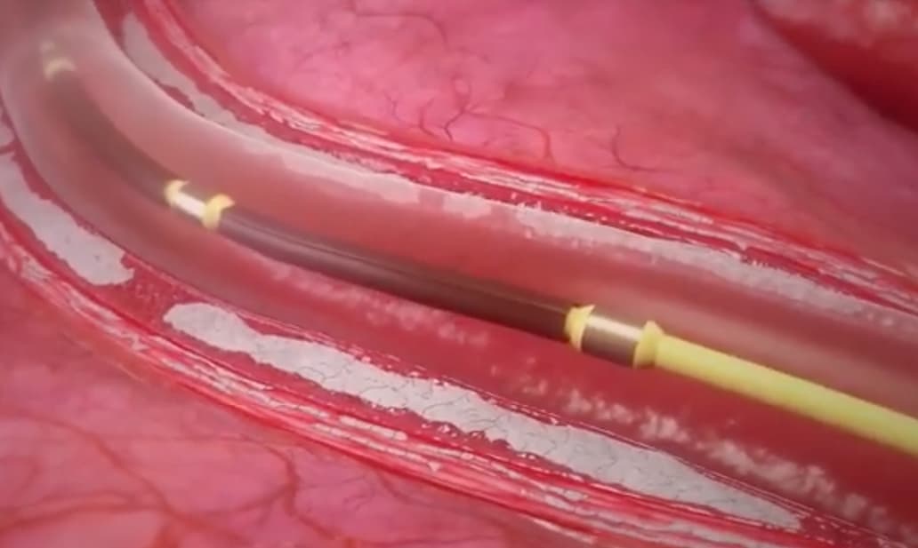 Illustration La lithotripsie intravasculaire se démocratise
