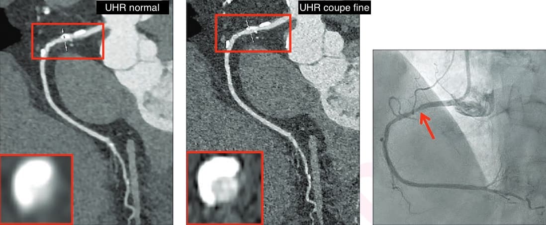 Illustration Quelle résolution pour l'exploration des coronaires calcifiées en tomodensitométrie ?