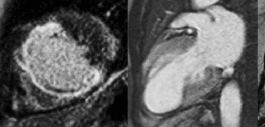 Illustration L'IRM cardiaque de stress plébiscitée pour l'évaluation de la maladie coronaire