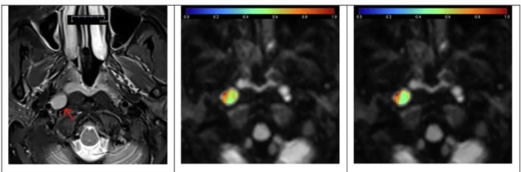 Illustration De nouveaux modèles d'IRM de diffusion pour distinguer les ganglions lymphatiques bénins et métastatiques cervicaux