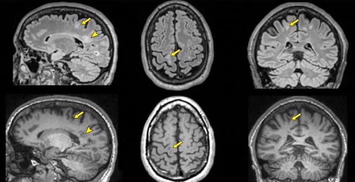Illustration Consensus européen autour de l'adoption clinique des QReports pour l'IRM de la SEP
