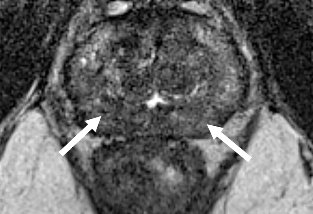 Illustration Quand et comment utiliser PI-RR et PI-RADS après traitement du cancer de la prostate ?