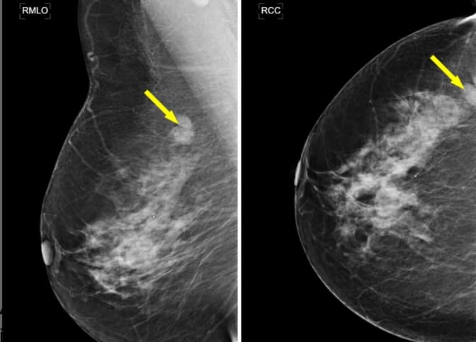 Illustration Un système de lecture hybride pour sécuriser l'intervention de l'IA dans le dépistage du cancer du sein