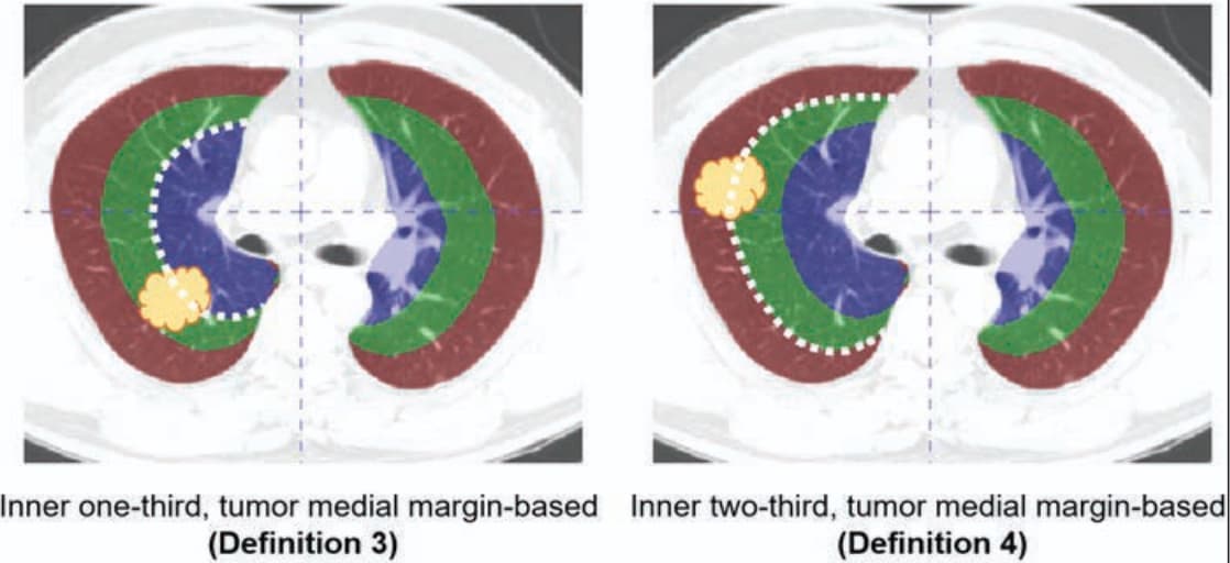Illustration Une bonne segmentation TDM pour un pronostic d'évolution plus juste du cancer du poumon