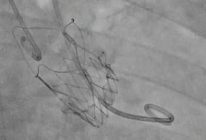 Illustration L'approche percutanée gagne du terrain dans la prise en charge européenne des pathologies valvulaires cardiaques
