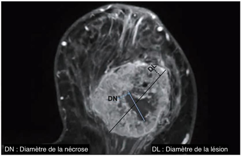 Illustration Cancer du sein triple négatif : un nouveau modèle IRM pour évaluer les effets précoces de la chimio-immunothérapie néoadjuvante