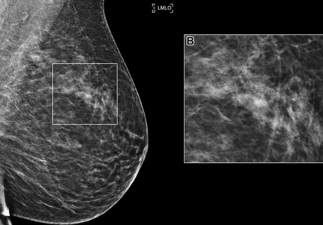 Illustration Des algorithmes très performants issus du dernier RSNA AI challenge pour la mammographie de dépistage