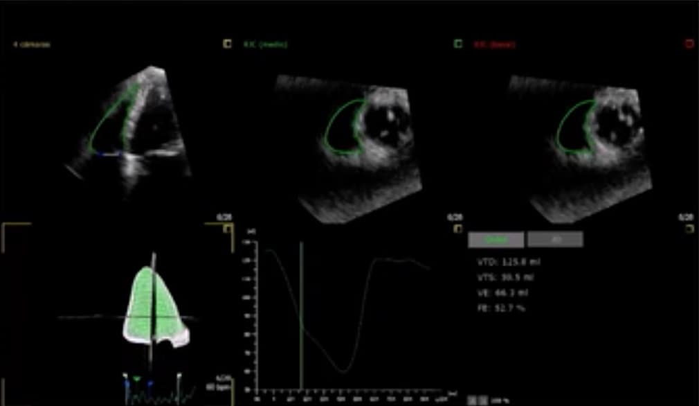 Les experts européens parlent de la prise en charge de la régurgitation tricuspidienne