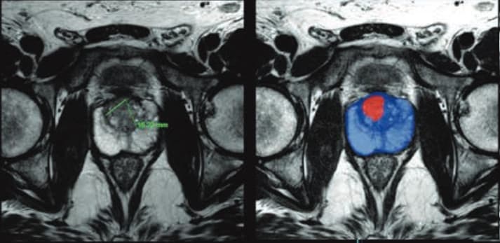 Les apports de l'IA pour le diagnostic du cancer de prostate par IRM biparamétrique