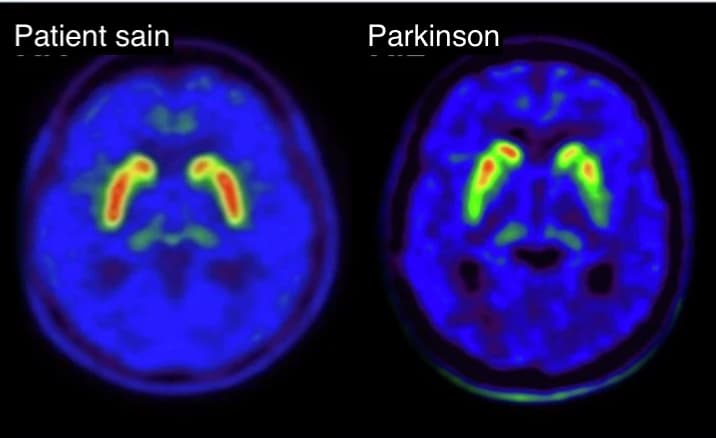 Un riche catalogue de biomarqueurs dédiés au TEP pour les maladies neurologiques
