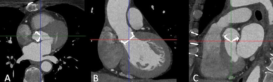 Recommandations internationales de bonnes pratiques pour la TDM d'évaluation des prothèses valvulaires cardiaques