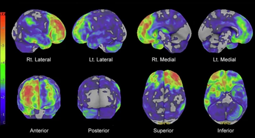 Illustration Une revue des troubles dégénératifs et de leurs signes radiologiques associés