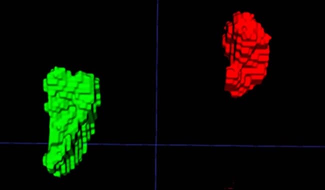 Des chercheurs américains découvrent un biomarqueur TDM du stress chronique