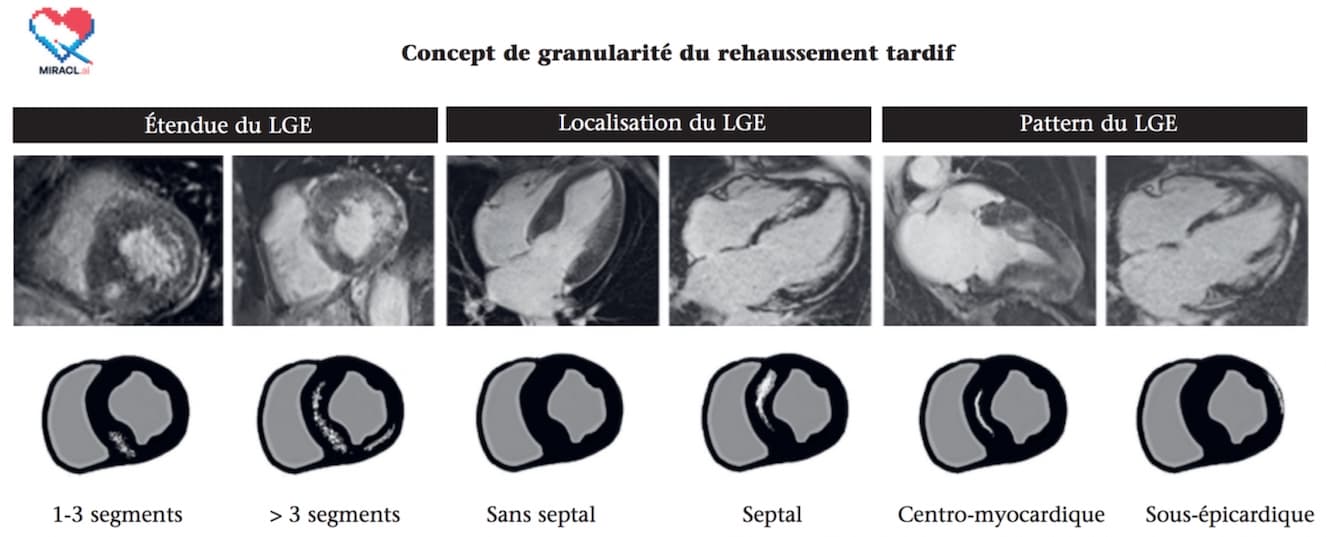 Identifier avec précision la granularité du rehaussement tardif du myocarde sous IRM pour évaluer le risque