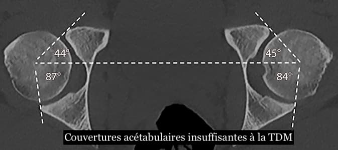 Illustration Un guide complet en imagerie multimodale de l'instabilité de hanche
