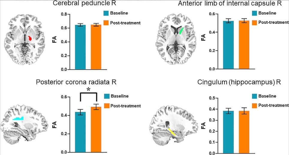 Illustration L'IRM prouve l'efficacité de l'acupuncture pour traiter le syndrome post-traumatique crânien
