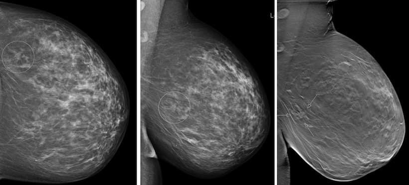 Illustration Identifier les faux positifs et faux négatifs dans le dépistage du cancer du sein par tomosynthèse