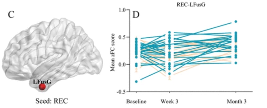 Illustration La stimulation électrique transcrânienne pour améliorer les performances cognitives des patients Alzheimer
