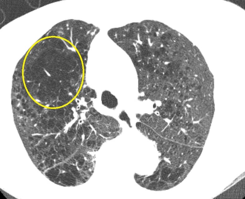 Illustration L'emphysème, nouvelle cible dans le cadre du dépistage des maladies pulmonairespar TDM low dose