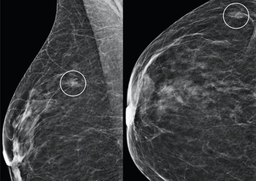 Illustration Comment interpréter le niveau intermédiaire de risque donné par l'IA dans le dépistage du cancer du sein ?