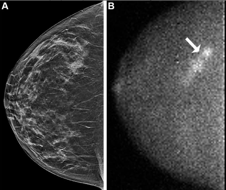 Illustration Une nouvelle étude plébiscite l'imagerie moléculaire en complément du dépistage du cancer du sein dense