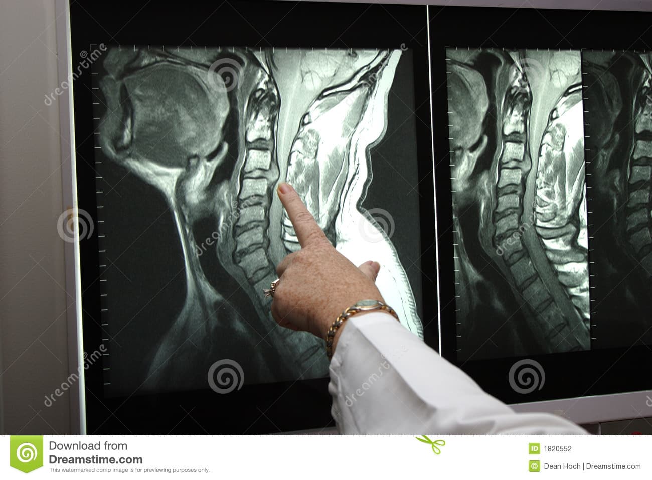 Illustration radiotheraîe