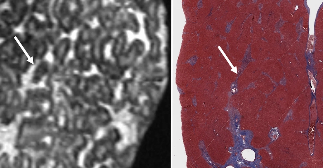 L'IRM 7T comme alternative à l'histopathologie pour l'étude de la fibrose hépatique ex vivo