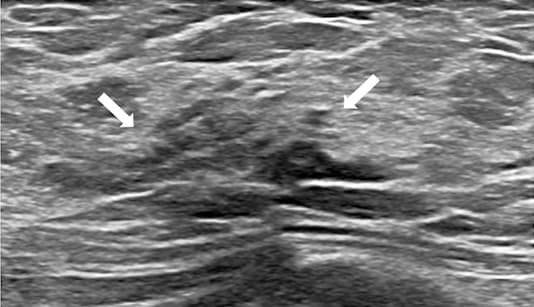 Un agrément inter-observateurs pour diagnostiquer les nodules mammaires