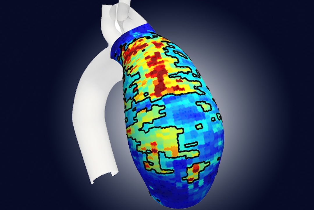 Quand la recherche en biomécanique tente de prévoir les ruptures d'anévrisme