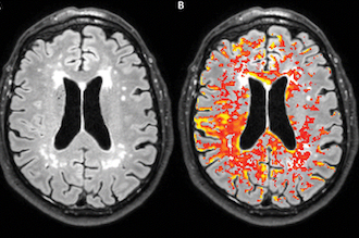 Alzheimer: le rôle de la barrière hémato-encéphalique étudié par IRM