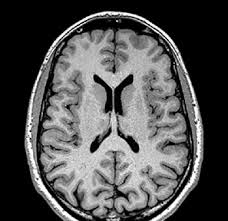 L'impact d'un stress post-traumatique étudié par IRM