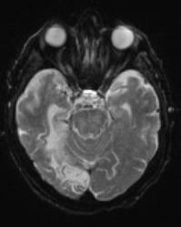 LE GADOLINIUM EST-IL DANGEREUX A LONG TERME ?