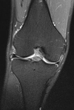 La chirurgie du ménisque favoriserait l'arthrose du genou