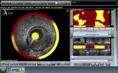 IVUS TVC