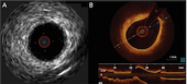 IVUS OCT