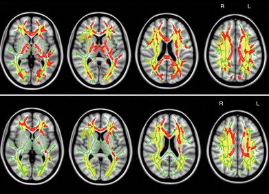 L'IRM classique pour identifier les lésions cognitives cérébrales