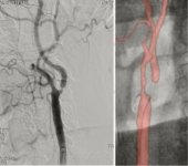 Sténose carotidienne