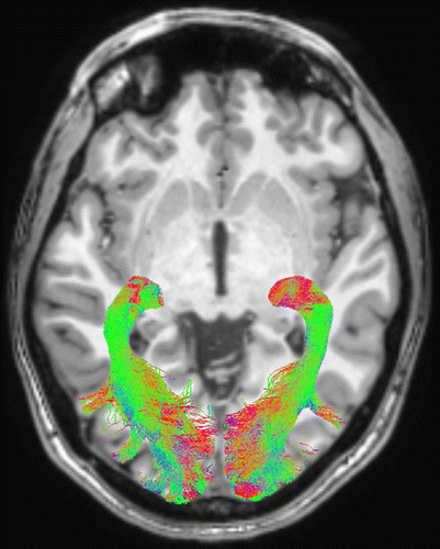 L'IRM de diffusion pour diagnostiquer les troubles non-moteurs du ...